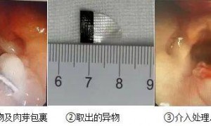 山东一名8个月宝宝差点儿窒息，“杀手”竟然是家长常忽视的它